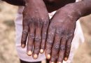 WHO Declares Rapidly Spreading Monkeypox Outbreak A Global Health Emergency